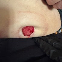 Fra 2-dels hård konveks til endels flad plade